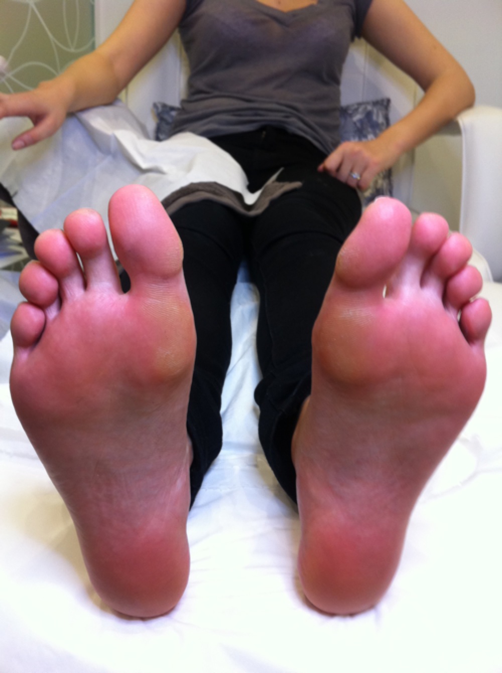 foot hard skin problems
